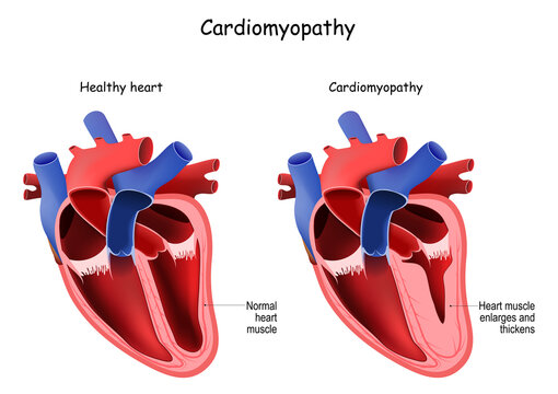 Cardiomyopathy. cross section of human's heart