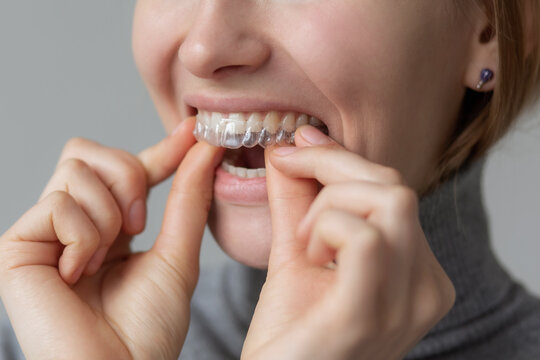 Transparent dentistry aligner