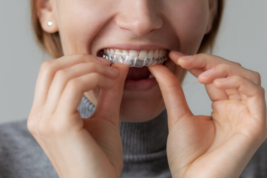 Woman taking out dentistry aligner from teeth