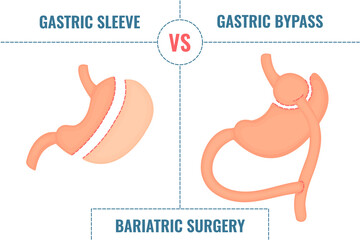 Gastric sleeve vs gastric bypass. Bariatric surgery weight loss procedures comparison. Stomach reduction anatomical diagram infographics. Health care  medical concept. Vector illustration. - obrazy, fototapety, plakaty