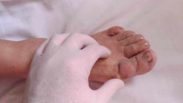 doctor inspecting old woman patient foot with a painful swelling on the joint of big toe, hallux big bone issue. closeup 4k video footage