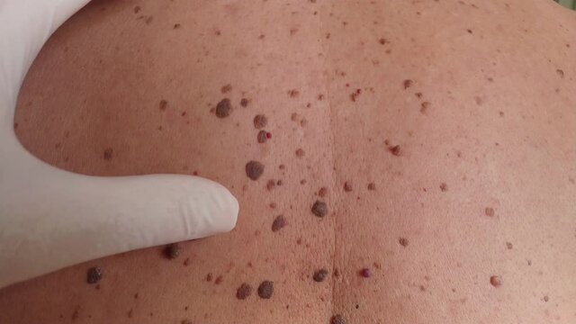 vertical handheld video of doctor inspecting back of patient with lot of warts nevuses, palpating by hand in a glove. closeup macro 4k footage