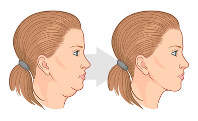 Double chin fat loss before and after vector illustration.  - obrazy, fototapety, plakaty