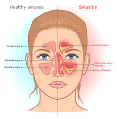 Fototapeta premium Sinusitis infection and normal sinuses medical diagram. 