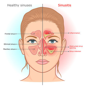 Sinusitis infection and normal sinuses medical diagram. 