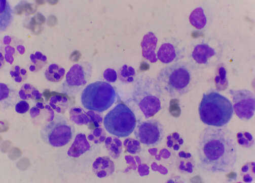 Mesothelial cells in body fluid sample.