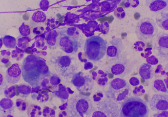 Mesothelial cells in body fluid sample.
