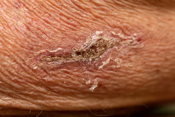 Fotobehang Closeup of flaking scab on wrinkled skin © Mark