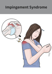 어깨충돌증후군 여성 증상