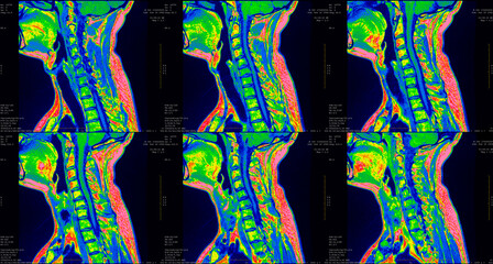 set of 6 sagittal green colored MRI scans of neck area of caucasian 34 years old male with...