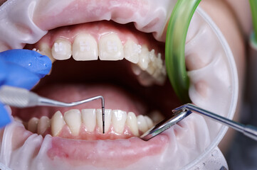 Macro photography. Top view on cleaning process in patient's mouth. Dentist using dental tools to check lower teeth. Cheek retractor on lips. Concept of dentistry, healthcare and oral medicine.