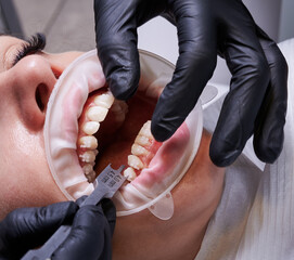 Close up of doctor in black gloves using aluminum bracket gauge while attaching braces to patient...