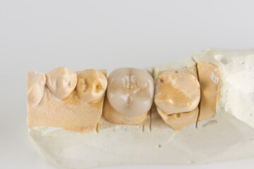 metal ceramic dental crown photographed close-up