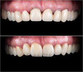 before and after picture of full mought reconstraction by crowns implants and veneers