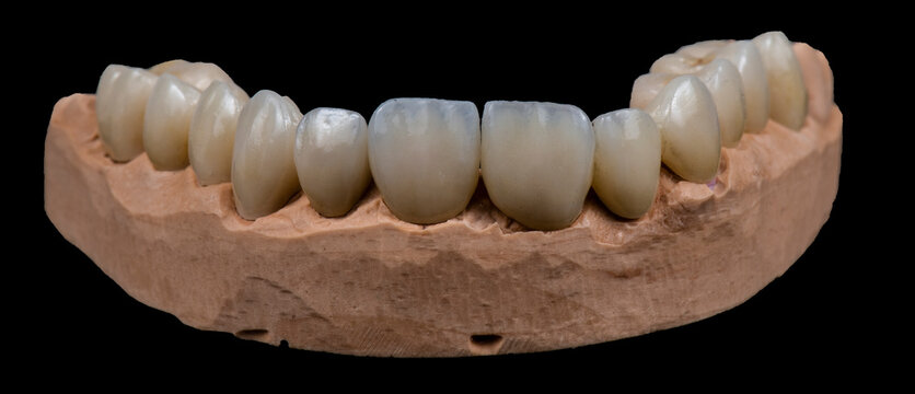picture of full mought reconstraction by crowns implants and veneers