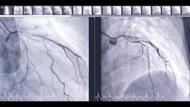 Coronary angiography is a test used to find out how much narrowing there is in coronary arteries for detect cardiac arrest ,Showing left coronary artery.