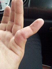 Picture of an dislocated finger ankle after sport accident