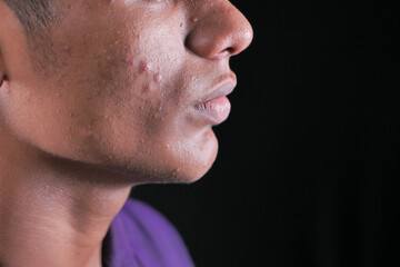 close up of young man face with skin problem .