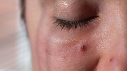 Acne on a woman's face close up. Portrait of a woman with problem skin
