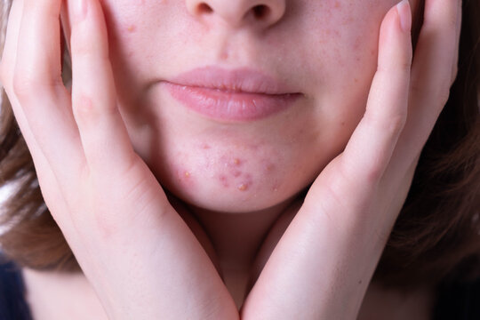 Inflammatory acne rash sprinkled on teen girl chin in close-up