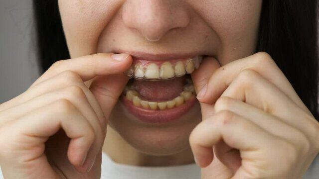 Woman is inserting removable transparent braces on the upper jaw and smiles. 