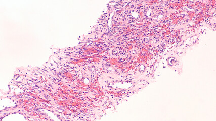 Kaposi's sarcoma is a type of cancer of blood vessels caused by a virus, herpesvirus 8 (HHV-8),...