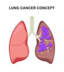 Lung cancer vector concept repiratory disease. Cartoon human lung cancer icon