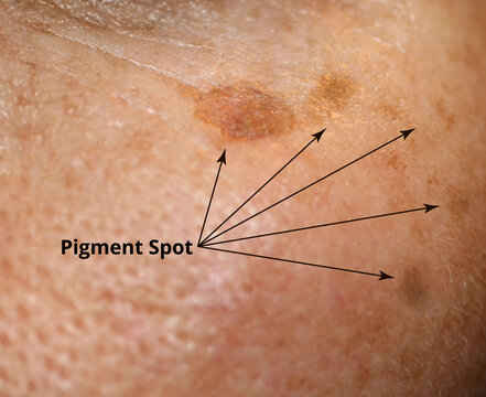 Brown spot on the skin of the face. Pigmentation on the skin