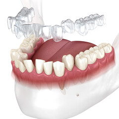Invisalign braces or invisible retainer make bite correction. Medically accurate 3D animation