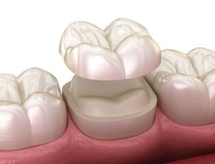 Onlay ceramic crown fixation over molar tooth. Medically accurate 3D illustration of human teeth treatment