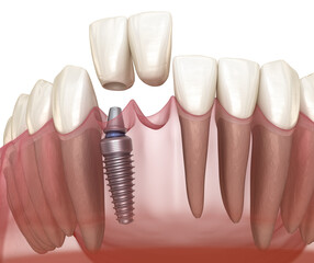Cantilever bridge implant based, frontal tooth recovery. Medically accurate 3D animation of dental concept