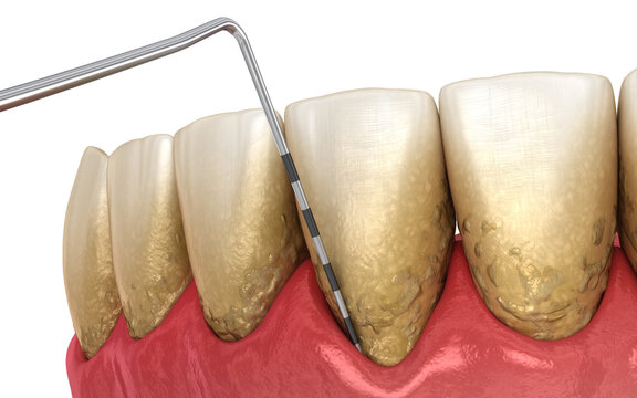 Periodontitis testing, gum recession process. Medically accurate 3D illustration
