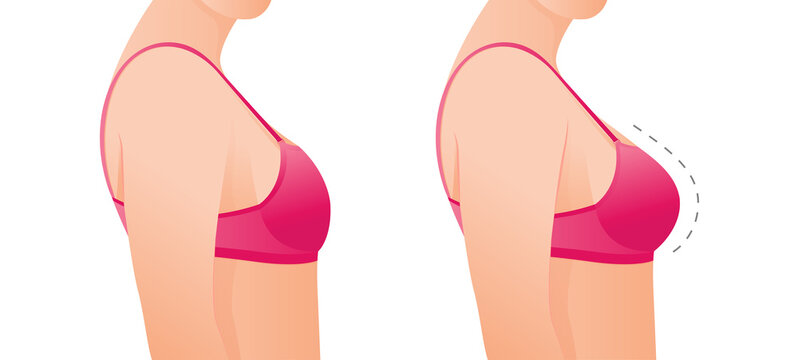 Female breasts in bra before and after augmentation/ breast size correction. Plastic surgery concept.woman body changing from overweight to slim as a result of training, dieting or Fitness workout.