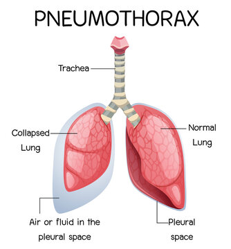 Pneumothorax cartoon of human anatomy