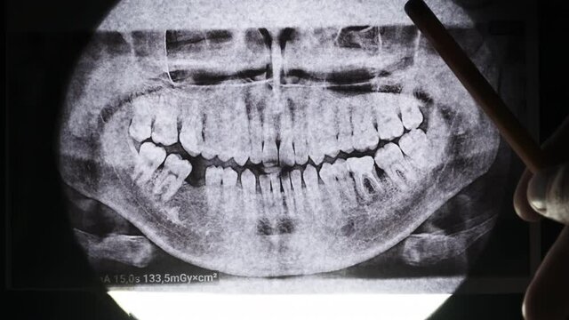 Dental X-Ray of Jaw with Teeth. Sealed Molars. Dentist Examines the Dental Arch