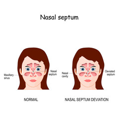 Nasal septum deviation - obrazy, fototapety, plakaty