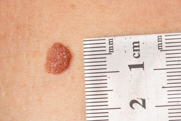 Big birthmark or mole with millimeters ruler