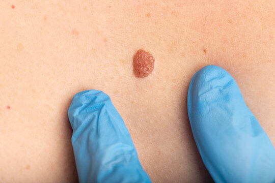 Doctor inspecting big mole on female body