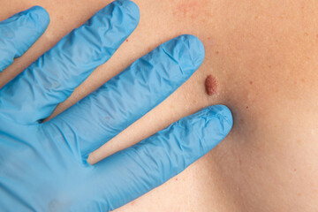 Checking up the mole on woman skin