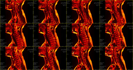 set of 12 sagittal red colored MRI scans of neck area of caucasian 34 years old male with bilateral...