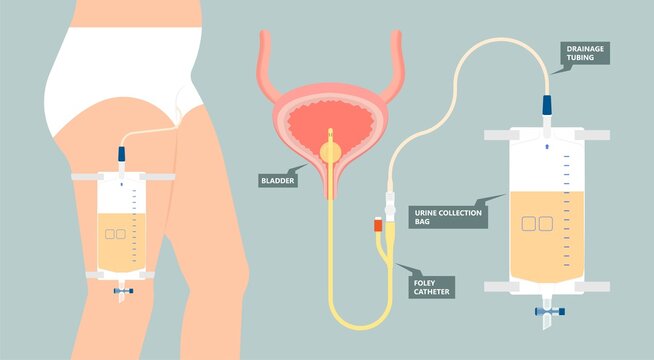 Urine Bag Medical Treatment Drainage Bladder Rubber Flexible Body Infection Bacteria Output Measure Tract Toilet Leg Relieve Cancer Device Calculi Vesical Problem Anatomy Sterile Surgical Urethra