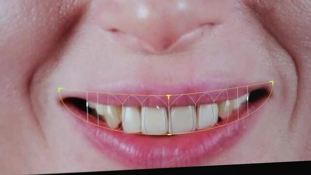 Orthodontist surgeon models dental veneers