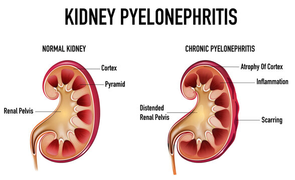 Informative illustration of Pyelonephritis