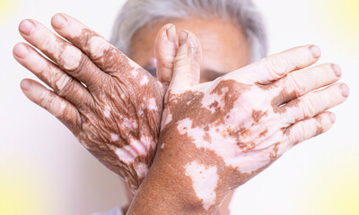 Vitiligo on the skin of a person, vitiligo on the hands or feet of the elderly, light fair