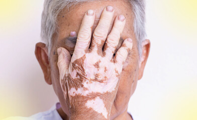 Fototapeta premium Vitiligo on the skin of a person, vitiligo on the hands or feet of the elderly, light fair