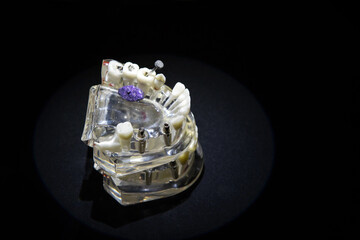 Titanium implants. A plastic model of the jaw with teeth for studying human anatomy and modeling future operations. Copy space