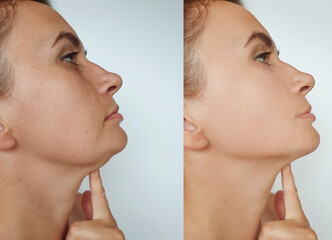 woman double chin before and after treatment