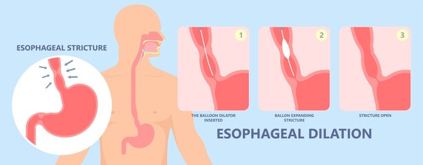 Dysphagia infection trachea examine Surgery choking gastric diagnose windpipe disorder bleeding surgical GERD treat tumor throat biopsy system ulcers stomach block eat food stuck test tract stent pain