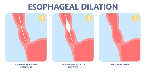 Dysphagia infection trachea examine Surgery choking gastric diagnose windpipe disorder bleeding surgical GERD treat tumor throat biopsy system ulcers stomach block eat food stuck test tract stent pain - obrazy, fototapety, plakaty