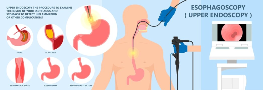 Dysphagia Infection Trachea Examine Surgery Choking Gastric Diagnose Windpipe Disorder Bleeding Surgical GERD Treat Tumor Throat Biopsy System Ulcers Stomach Block Eat Food Stuck Test Tract Stent Pain